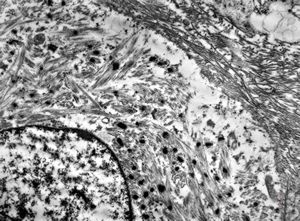 F,17y. | neck - rhabdomyosarcoma F,17y. | neck - rhabdomyosarcoma